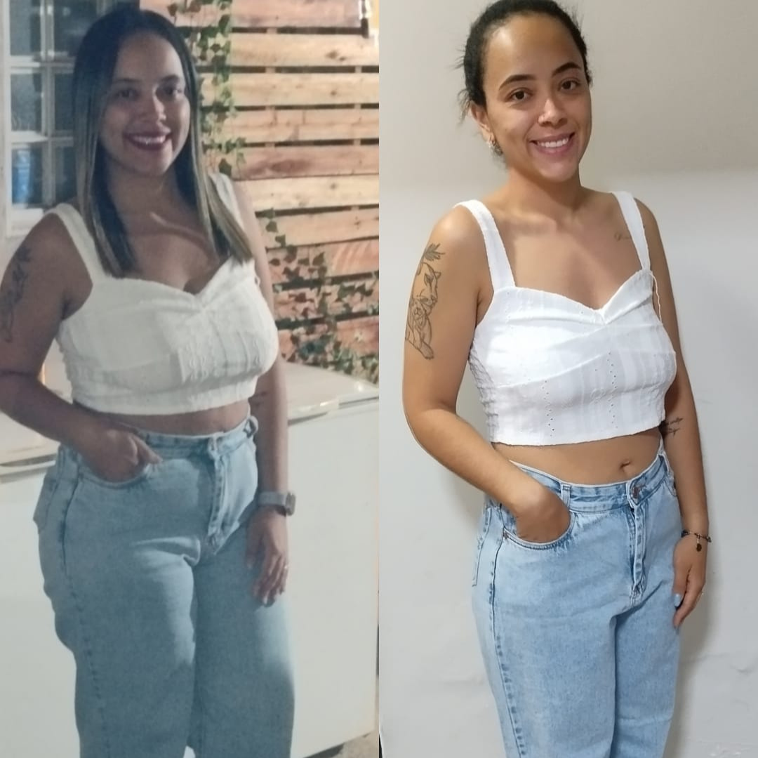Paciente H - antes e depois