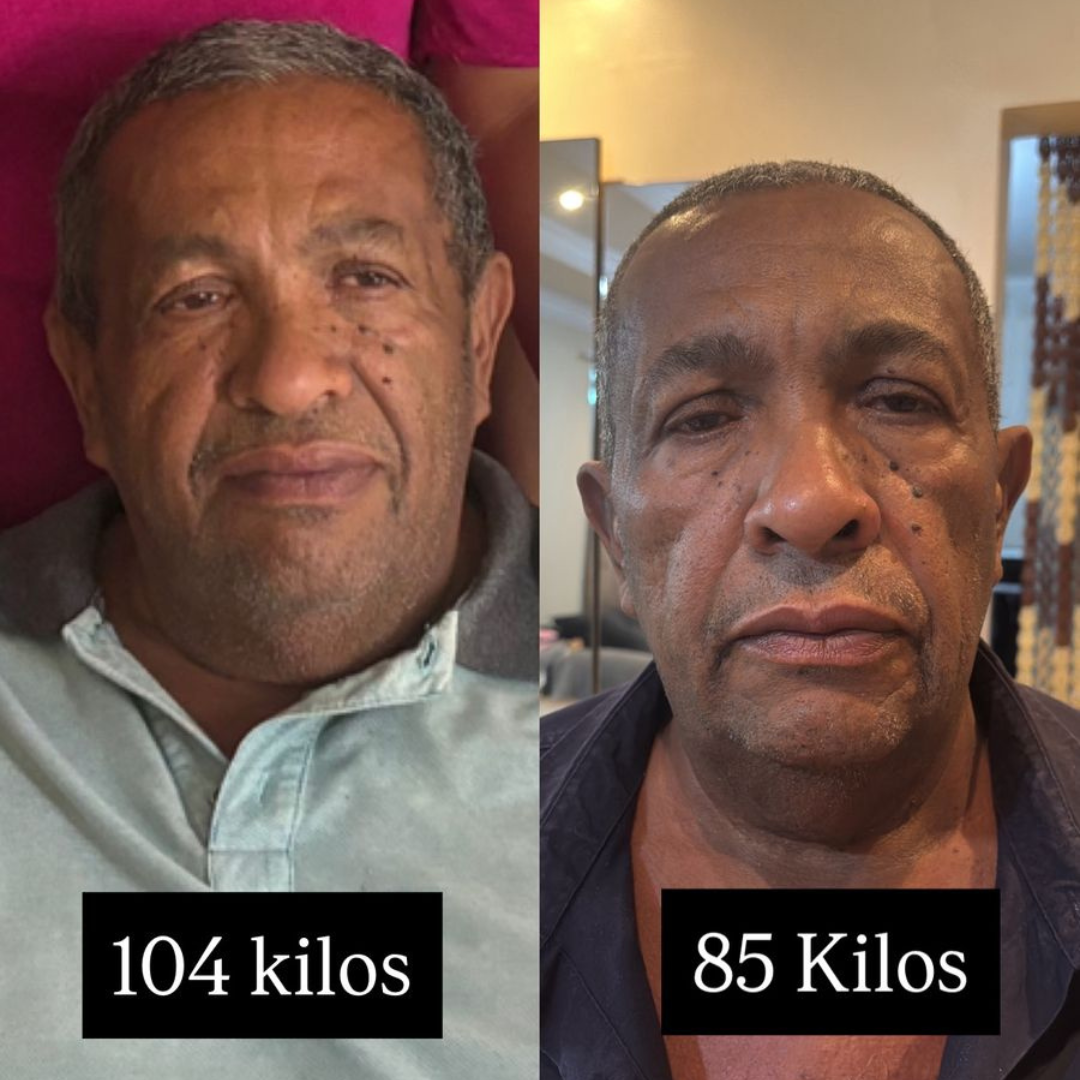 Paciente G - antes e depois