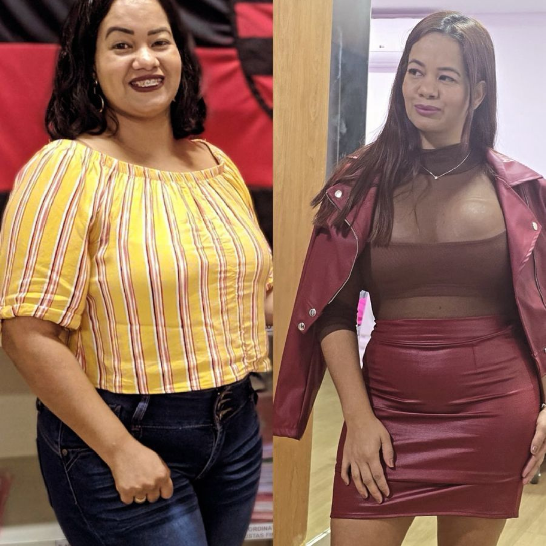 Paciente E - antes e depois